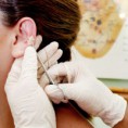 Auriculoterapia